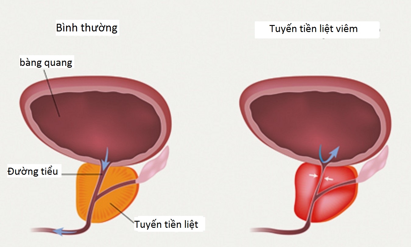 Tìm hiểu về bệnh viêm tuyến tiền liệt và cách điều trị