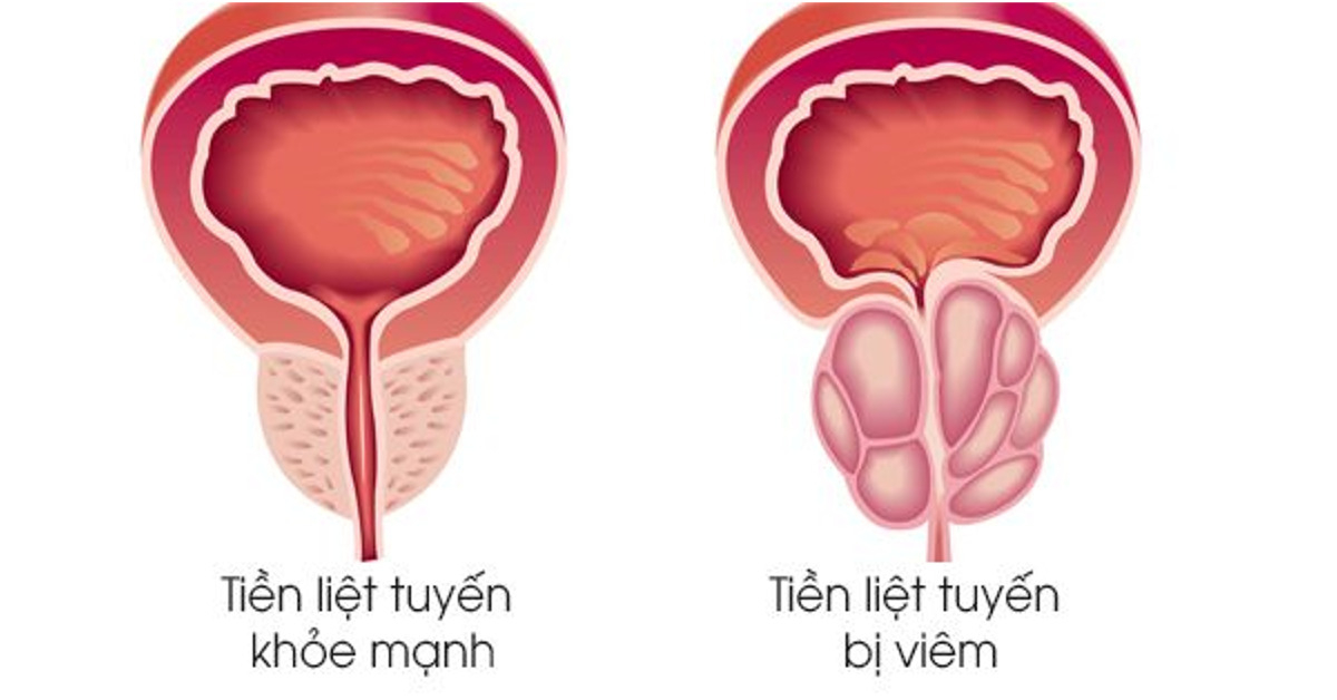 Giải đáp thắc mắc bệnh viêm tuyến tiền liệt có chữa khỏi không