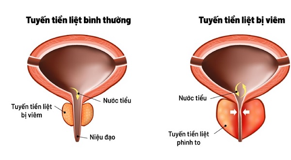 Cách phát hiện sớm các biểu hiện viêm tuyến tiền liệt