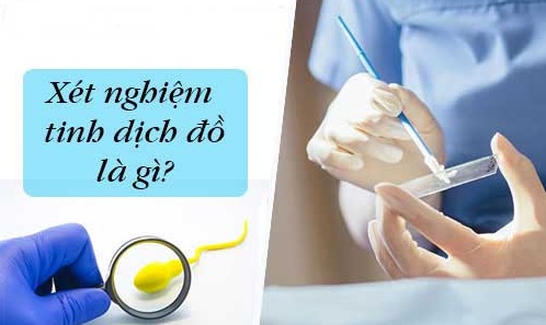 Những điều cần biết về xét nghiệm tinh dịch đồ