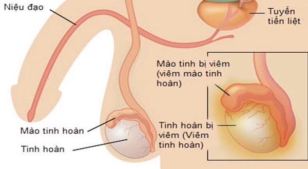 Triệu chứng viêm mào tinh hoàn và cách hỗ trợ điều trị nhanh khỏi